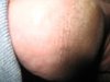 hipforums_cracking_soles_heel_08_17_2015.jpg