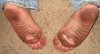 soles_when_drained_blisters_did_not_reattach_trimmed_blisters.jpg